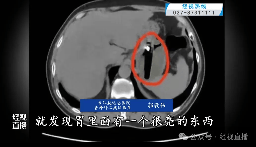 湖北武汉一男子疑酒后吞下一枚长约8厘米打火机,反复摩擦胃窦一个月引发巨大溃疡